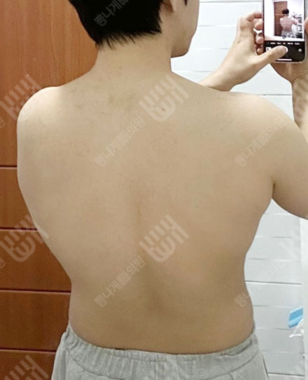 ผู้ชายดูดไขมันแผ่นหลัง1 전