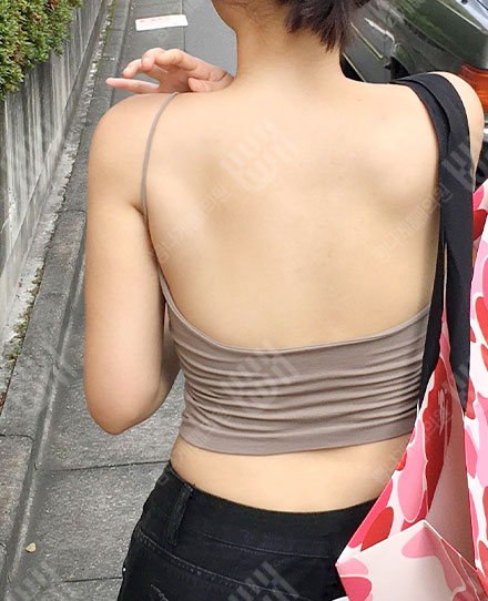 ดูดไขมันแผ่นหลัง1 후