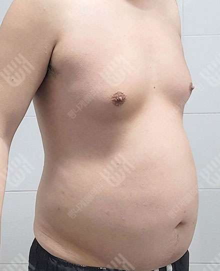 ลดไขมันหน้าอกผู้ชาย3 전