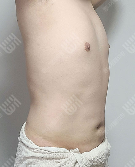 ลดไขมันหน้าอกผู้ชาย3 후