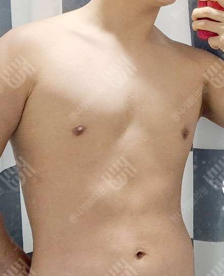 ลดไขมันหน้าอกผู้ชาย2 후