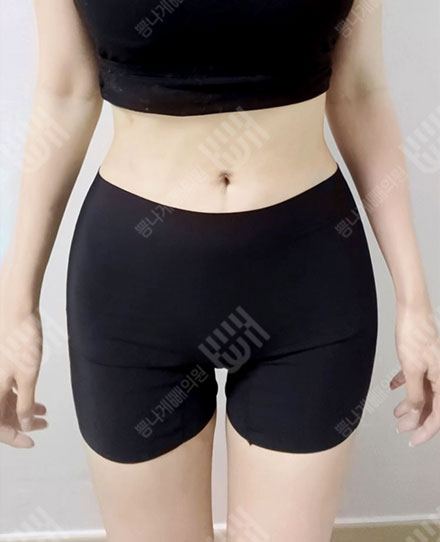 ฉีดไขมันเสริมสะโพก8 후