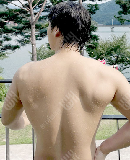 ผู้ชายดูดไขมันแผ่นหลัง1 후