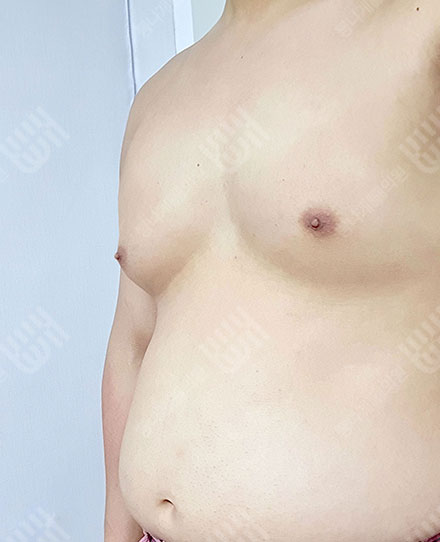 ลดไขมันหน้าอกผู้ชาย2 전