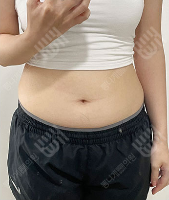 Before: ก่อนผ่าตัด