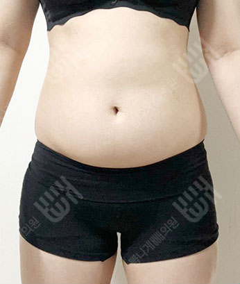 Before: ก่อนผ่าตัด