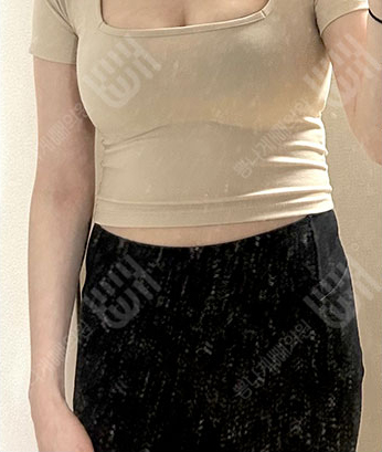 Before: ก่อนผ่าตัด