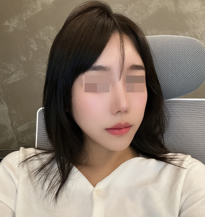 BBAE CLINIC ฉีดไขมันปรับรูปหน้า
