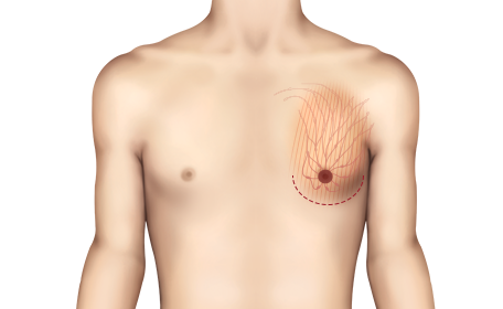 Gynecomastia ชนิดแท้ 