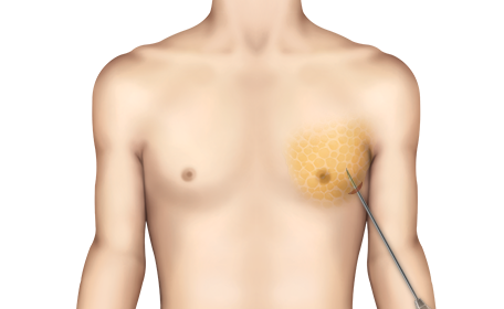 Gynecomastia ชนิดเทียม 