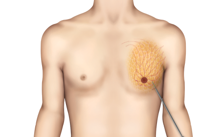 Gynecomastia แบบผสม 