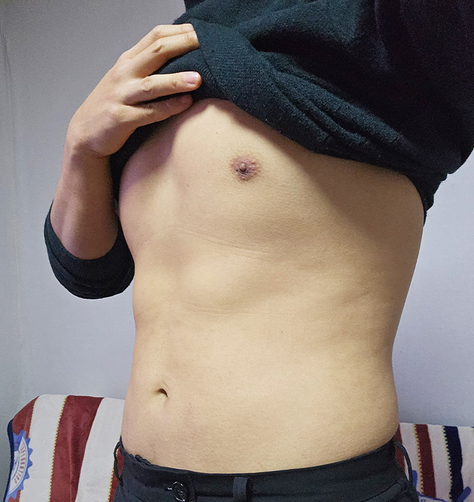 BBAE CLINIC ลดไขมันหน้าอกผู้ชาย