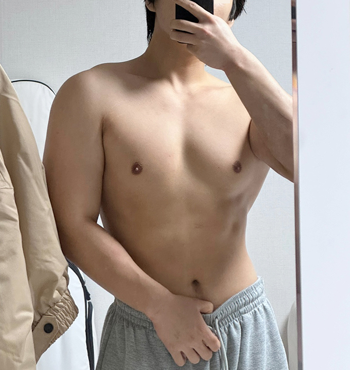 BBAE CLINIC ดูดไขมันหน้าท้อง